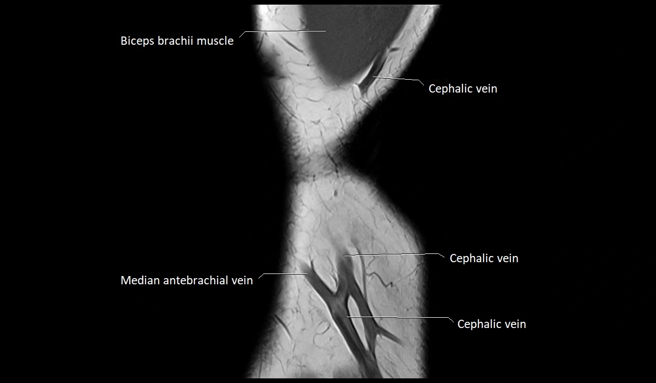 Elbow coronal anatomy image  cross sectional 3T MRI image 3.webp